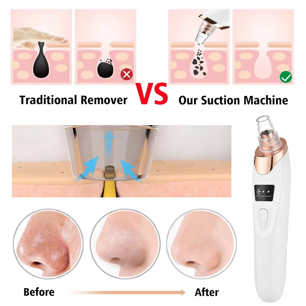 Blackhead Remover Machine – Deep Cleaning Vacuum for Acne & Pores | Skin Care Tool
